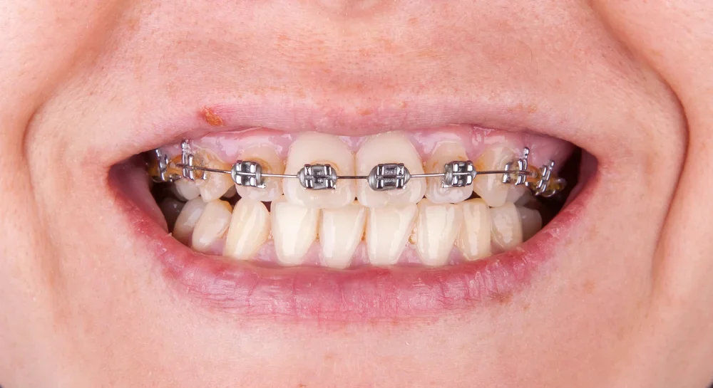 After Dental Treatment